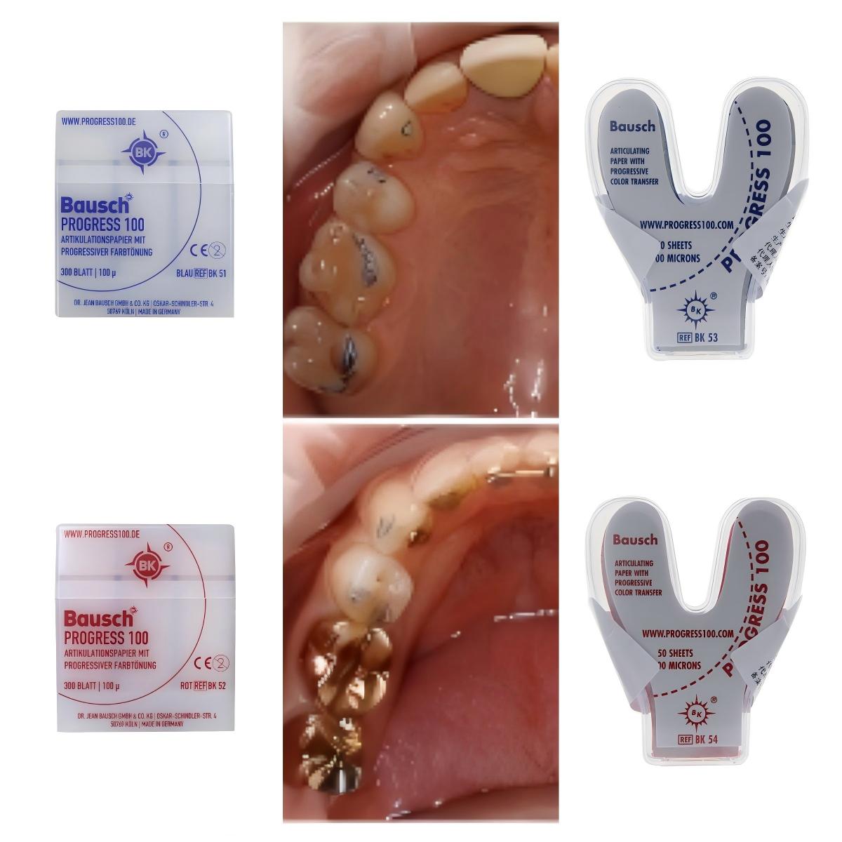 Bausch BK51 BK52 BK53 BK54 Den - Bite Indicator recensione e prezzo